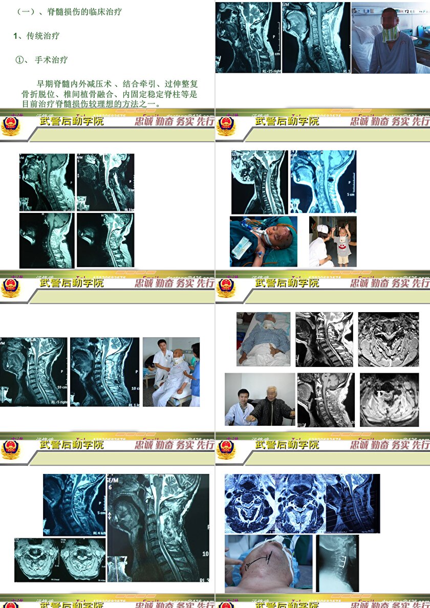 2023年脊髓損傷研究新進(jìn)展，里程碑式的突破與日常奇妙變化