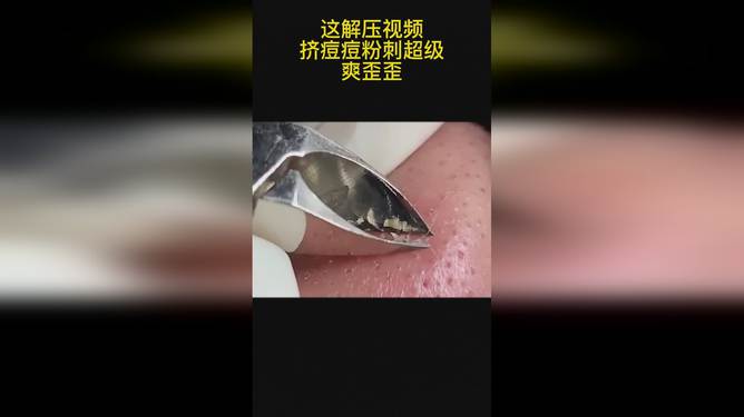 最新擠膿包視頻，見證變化的力量，自信與成就感的誕生之地