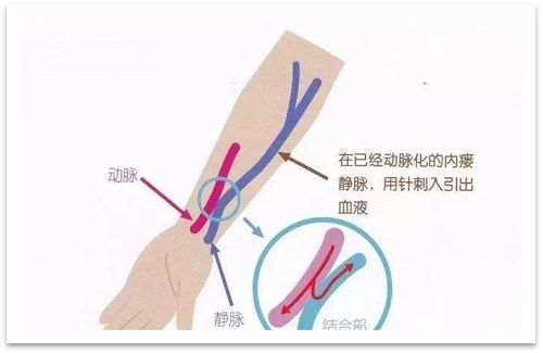靜脈瘺最新資訊，掌握最前沿的健康信息